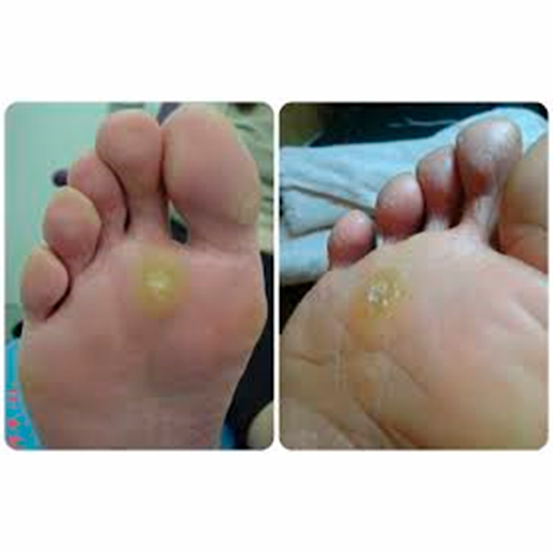 HELOMA PLANTAR Y DORSAL2
